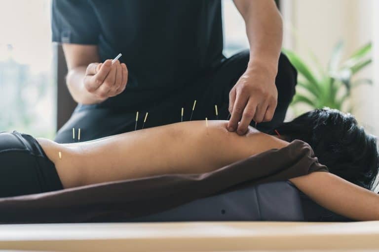 Therapist Giving acupuncture Treatment To Young Woman