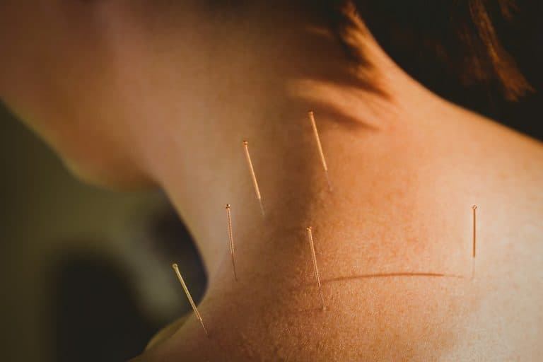 Young woman getting acupuncture treatment in therapy room